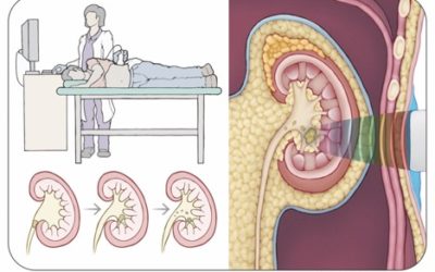 2pBAa1 – New way to treat kidney stone sufferers – Michael Bailey