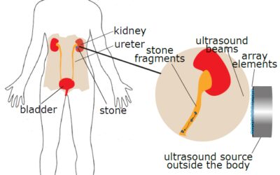 2aPAb – Ultrasound technology to remove kidney stones